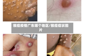猴痘疫情广东哪个地区/猴痘症状图片